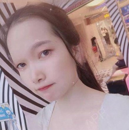 去眼袋手术