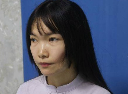 去眼袋手术