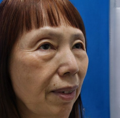 去眼袋手术