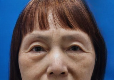 去眼袋手术