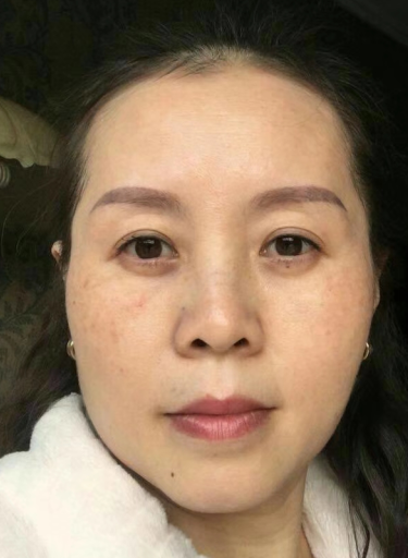 去眼袋手术