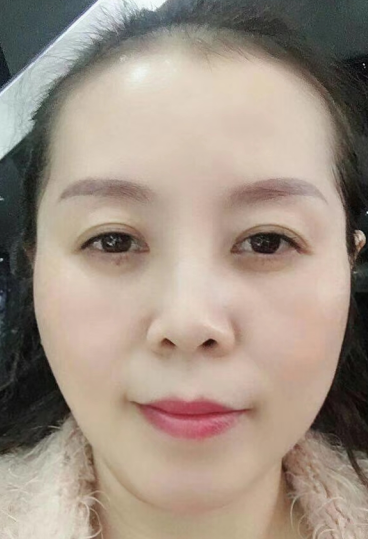 去眼袋手术