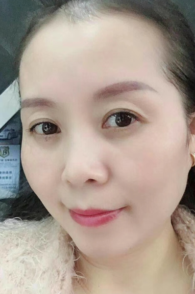 去眼袋手术
