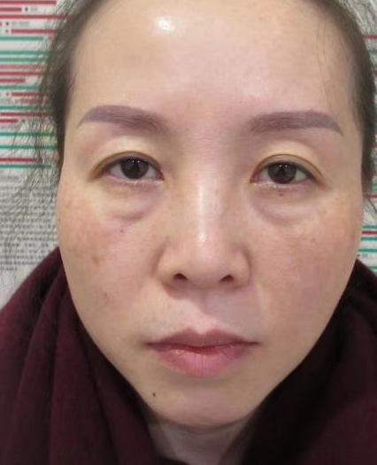 去眼袋手术