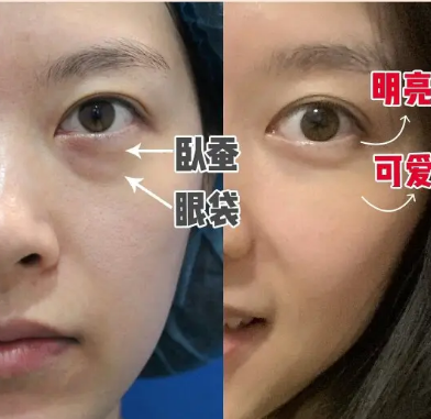 去眼袋手术