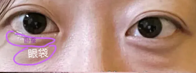 去眼袋手术