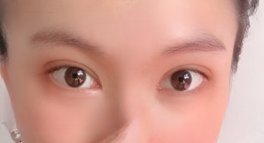 双眼皮手术