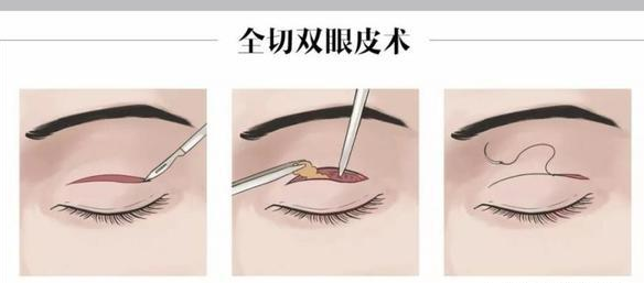 双眼皮手术
