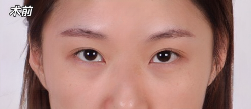 双眼皮手术