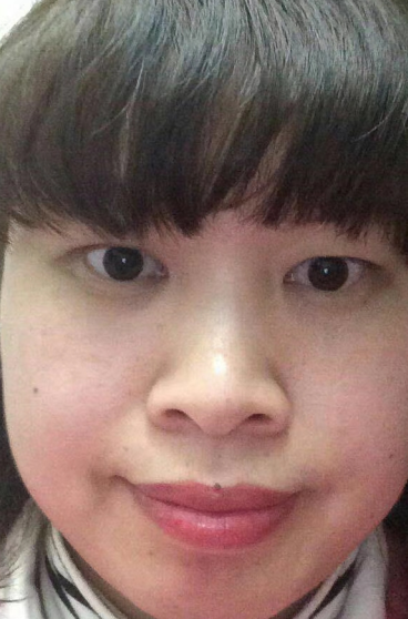 去眼袋手术