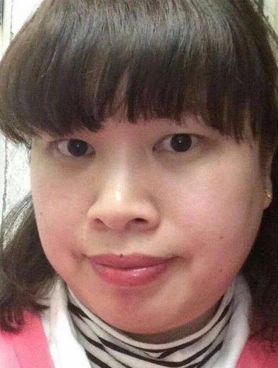 去眼袋手术