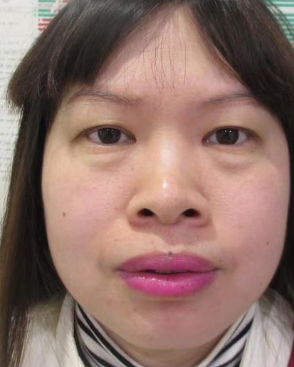 去眼袋手术