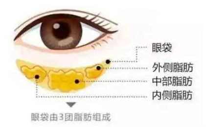 去眼袋手术
