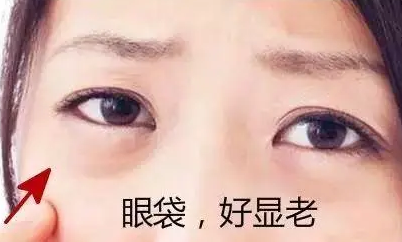 去眼袋手术