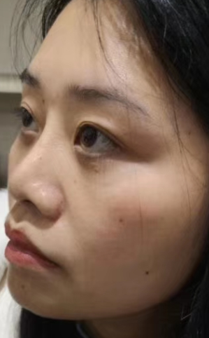 眼袋术