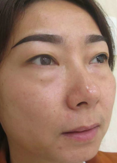 去眼袋手术