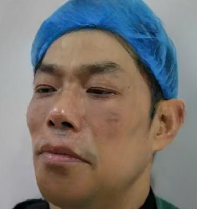 去眼袋手术