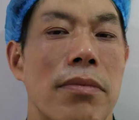 去眼袋手术