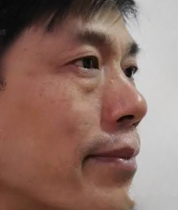 去眼袋手术