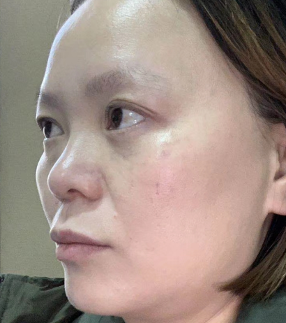 去眼袋手术