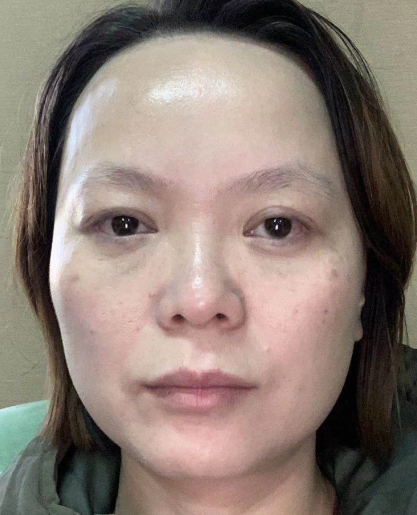 去眼袋手术