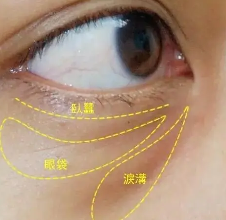 眼袋术