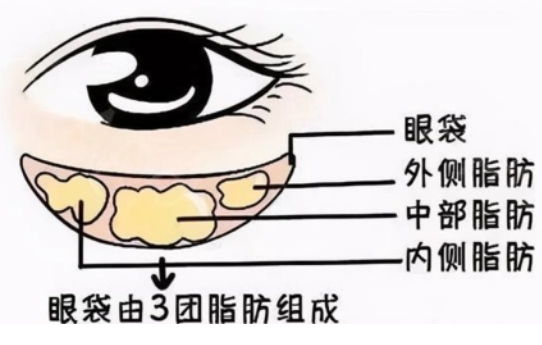 去眼袋手术