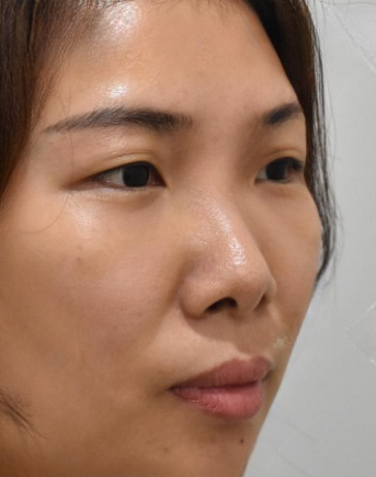 去眼袋手术