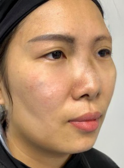 去眼袋手术