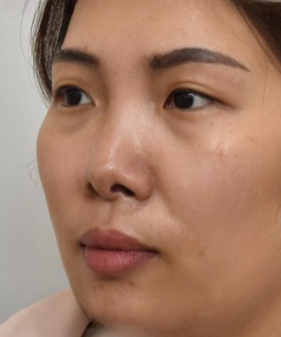 去眼袋手术
