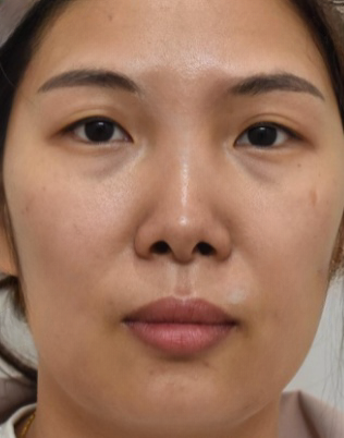 去眼袋手术