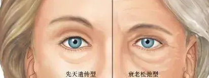 去眼袋手术