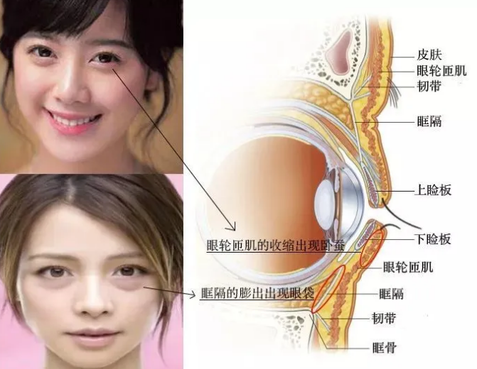 去眼袋手术