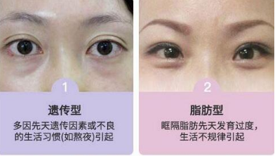 去眼袋手术