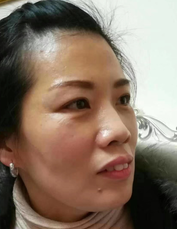 去眼袋手术