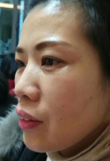 去眼袋手术