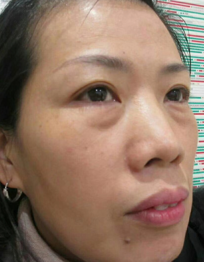 去眼袋手术