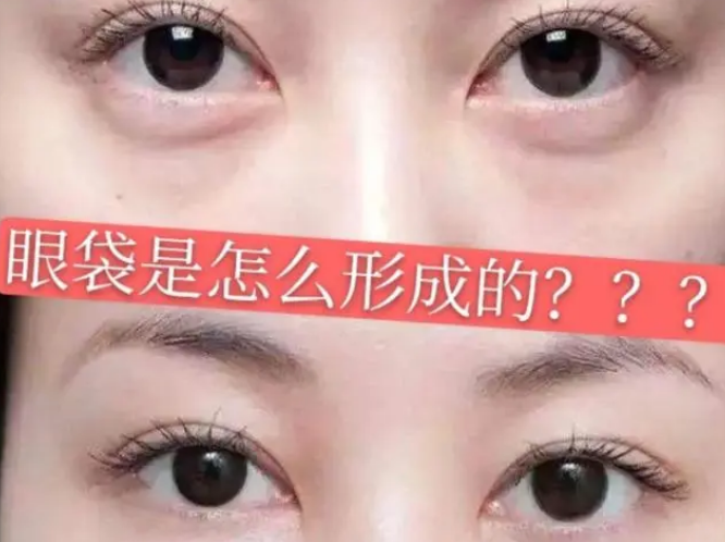 去眼袋手术