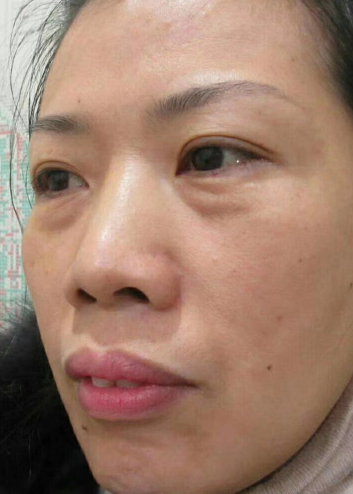 去眼袋手术