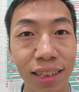 眼袋