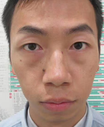 眼袋