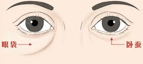 眼袋