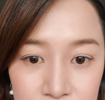 去眼袋手术