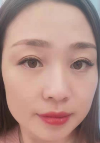 去眼袋手术