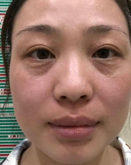 去眼袋手术