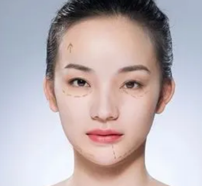 去眼袋手术