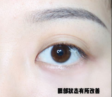 眼袋
