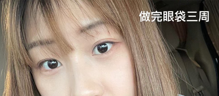 眼袋