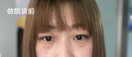 眼袋