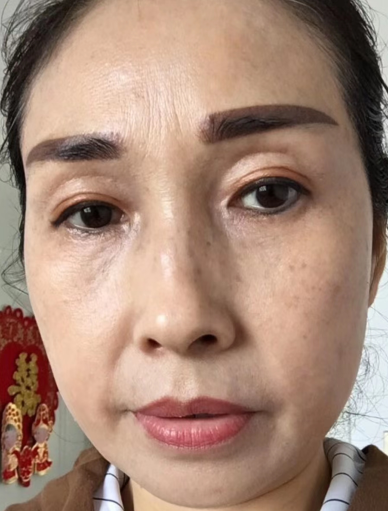 眼袋